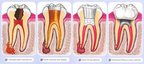 RCT -Root-Canal-Treatment