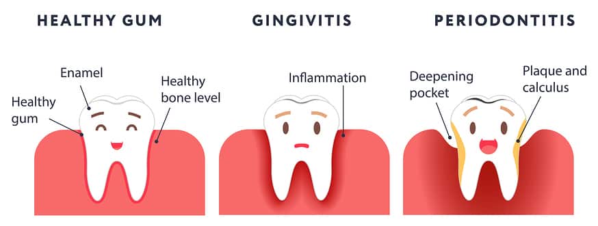 Gingivitis stages