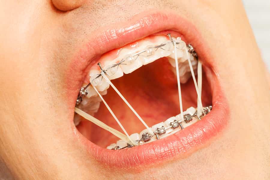 braces mouth open orthodontic metal clear aligners rings teeth vs rubber dental lips tooth bracket comfortable before wearing