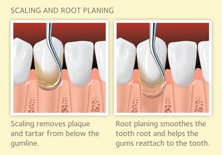 scaling and root planing procedure