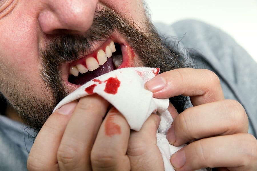 FAQs on bleeding gums