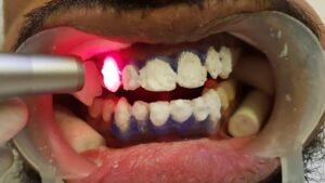 Laser teeth whitening procedure