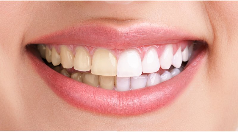laser teeth whitening before and after