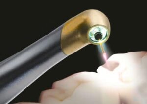 contactless cavity filling using er yag laser