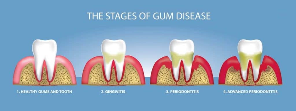 stages of gum diseases