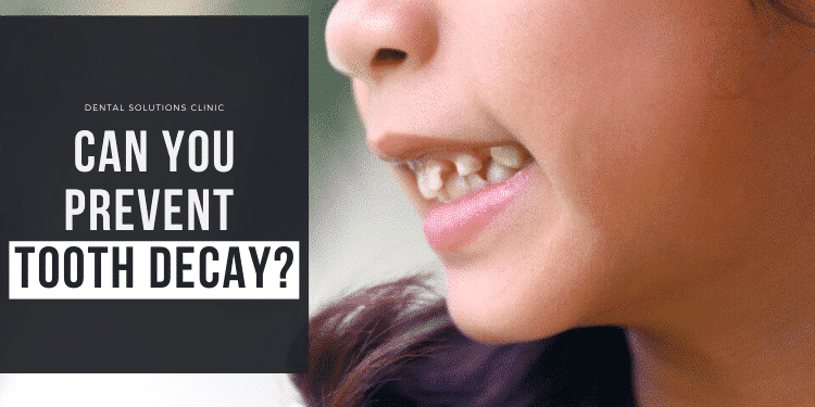 Can you prevent tooth decay?