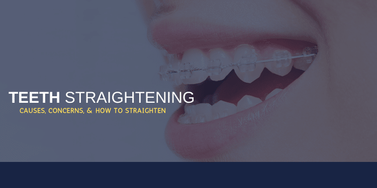 Teeth Straightening –  Causes, Concerns, and How to Straighten