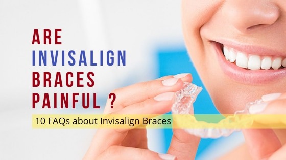 10 Important FAQs about Invisalign Braces