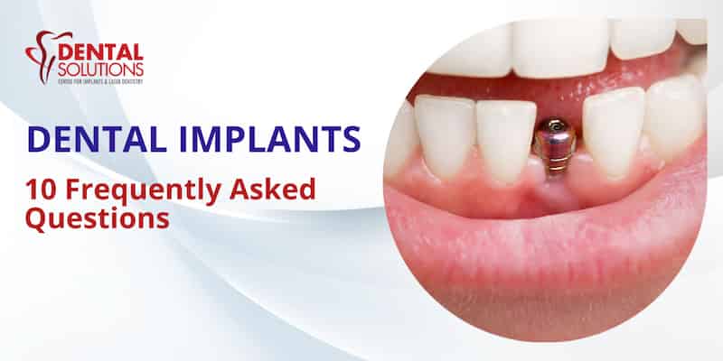 The top 10 FAQs on dental implants