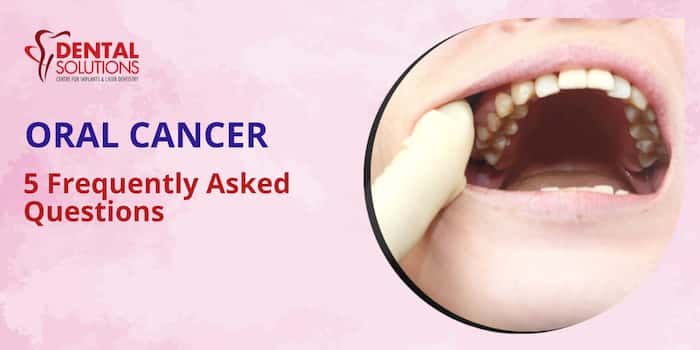 Oral Cancer – 5 Frequently asked questions
