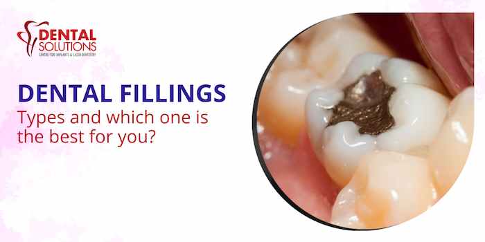 Types of Dental fillings