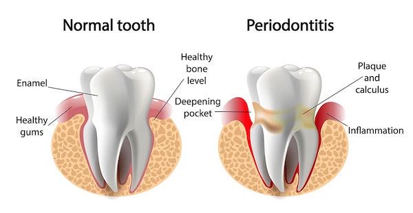 Normal Tooth vs Periodontitis tooth