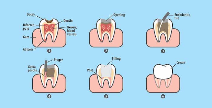 Root canal therapy procedure