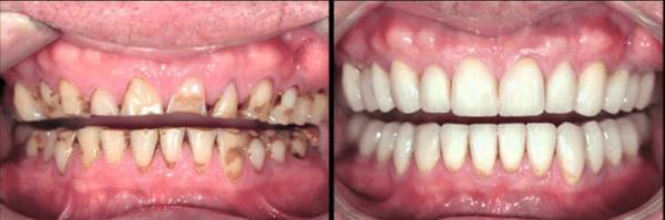 Full-mouth-rehabilitation-before-and-after