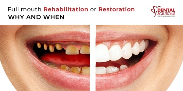 Full mouth rehabilitation or restoration