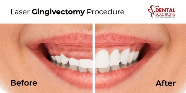 Laser gingivectomy procedure in bangalore