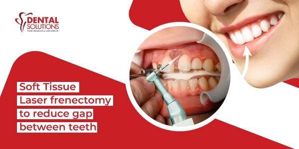 Soft Tissue Laser Frenectomy to reduce the gap between teeth
