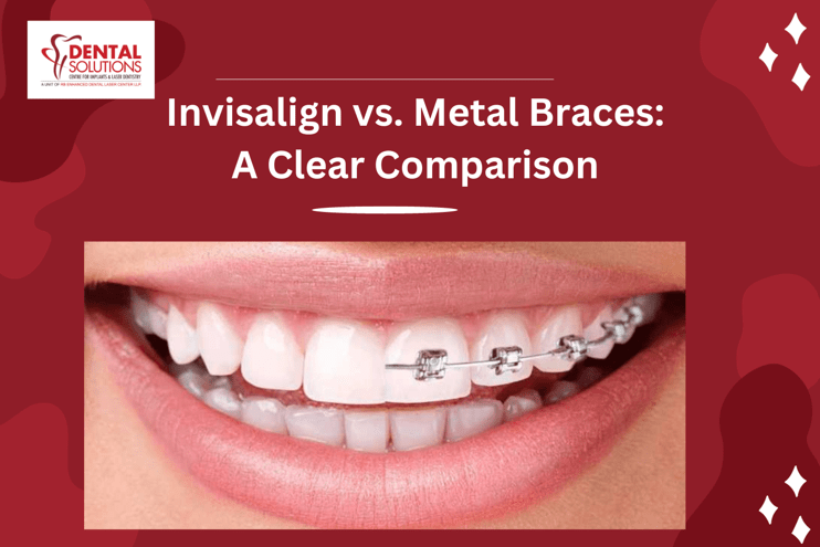 Invisalign Aligners or Traditional Braces? Find Out Which Is Best