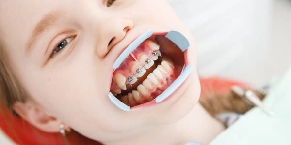 How-are-braces-fitted-in-children